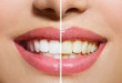 Sự thật đến lúc bạn cần biết lấy cao răng có làm trắng răng không?