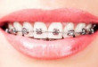 Niềng răng có tốt không? >>> Chuyên gia hàng đầu nha khoa giải đáp