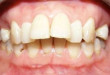Nguyên nhân gây răng vẩu phổ biến không phải ai cũng biết