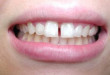 Thế nào là răng thưa và cách điều trị chuẩn không cần chỉnh