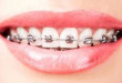 Chia sẻ kinh nghiệm về răng hơi hô có nên niềng không?