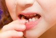 Cách khắc phục khi răng cửa bị lung lay hiệu quả nhất >>> Xem ngay