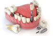 Cắm răng implant ở đâu uy tín? Địa chỉ an toàn, giá rẻ nhất hiện nay