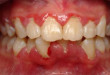 Tìm hiểu viêm quanh răng là gì?