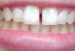 Phương pháp điều trị răng thưa bằng dịch vụ thẩm mỹ