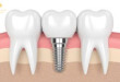 Cấy ghép implant OPP 300 – Công nghệ cấy ghép răng hiện đại hiện nay