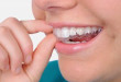 Tìm hiểu về máng điều trị nghiến răng