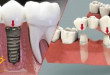 Nên làm implant hay cầu răng – Chia sẻ từ chuyên gia