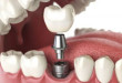 Video trồng răng implant hoàn chỉnh tại Nha khoa Dencos Luxury
