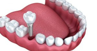 Chia sẻ kinh nghiệm: Có nên trồng răng Implant không? 