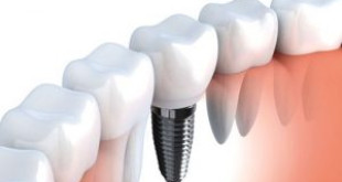 Địa chỉ ghép răng Implant ở đâu tốt? – Sự lựa chọn hoàn hảo cho bạn 
