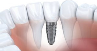 Chi phí làm răng implant giá bao nhiêu tiền là phù hợp nhất?