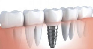 Làm răng implant có đau không thưa bác sĩ? 