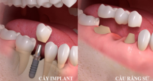 Người mất răng nên làm cầu răng hay Implant thì tốt hơn?