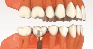 Quy trình cấy ghép răng implant được thực hiện như thế nào? 