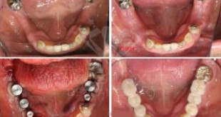 Quy trình trồng răng Implant được thực hiện như thế nào?