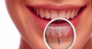 Những thông tin bạn chưa biết về cắm răng Implant là gì?