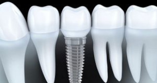 Địa chỉ ghép răng Implant ở Hà Nội