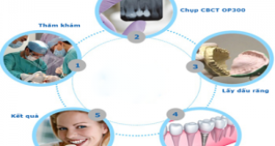 Quy trình cắm răng Implant diễn ra như thế nào?