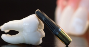 Thông tin cần biết về ghép răng Implant là gì?