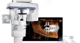 Trồng răng bằng phương pháp Implant OP300 hiện đại