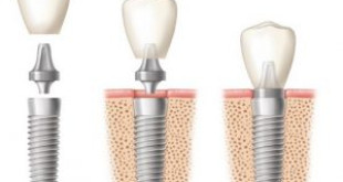 Địa chỉ trồng răng implant nào uy tín tại hà nội?