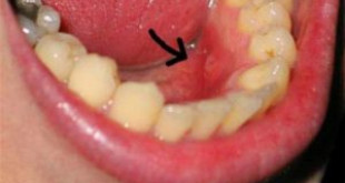 Tại sao răng có màu vàng – Nguyên nhân làm vàng răng