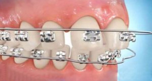 Niềng răng thưa mất bao lâu thời gian để có hàm răng hoàn mỹ nhất?