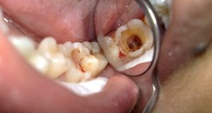 Nguyên nhân bị sâu răng bạn thường mắc phải