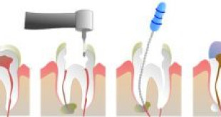 Điều trị tủy răng như thế nào? – Chuyên gia Nha khoa