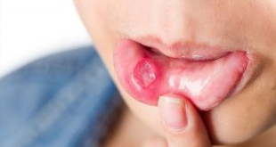 Cách chữa bệnh lở miệng hiệu quả, an toàn và không bao giờ tái phát