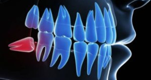 Răng khôn có mọc ở hàm trên không và cách xử lý tốt nhất hiện nay