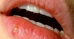 Bật mí những triệu chứng bệnh lở miệng giúp bạn sớm nhận biết