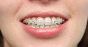 Phương pháp niềng răng vẩu hiệu quả nhất năm 2017