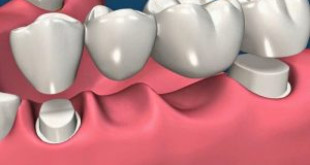 Cầu răng sứ là gì? [Giải đáp từ chuyên gia]