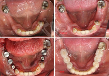 Quy trình trồng răng Implant được thực hiện như thế nào?