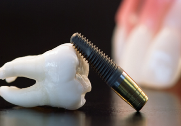 Thông tin cần biết về ghép răng Implant là gì?
