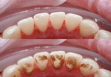 Lấy cao răng có ảnh hưởng gì không? >>> Nghiên cứu nha khoa