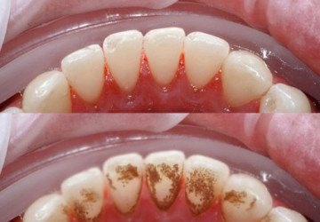 Hot “Quy trình lấy cao răng như thế nào” mới là chuẩn quốc tế?