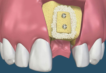Cấy ghép xương răng – Tại sao cần thực hiện kỹ thuật này